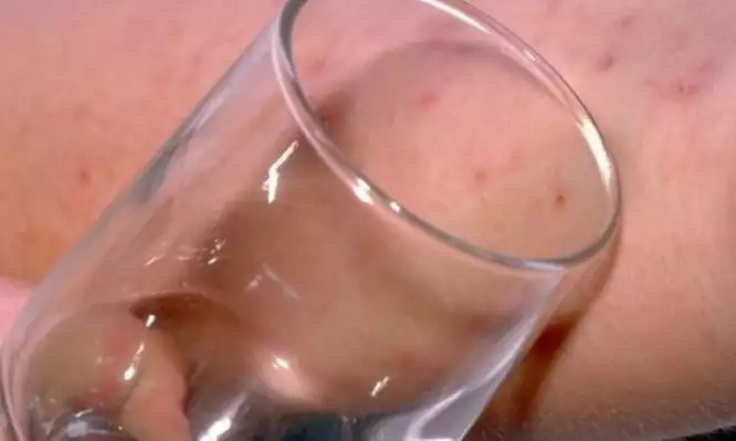 Το σημάδι στο δέρμα από μηνιγγίτιδα: Πώς γίνεται το τεστ με το ποτήρι
