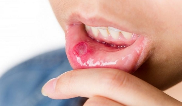 Άφθες στο στόμα: Τι πρέπει να ξέρετε για την μυκωτική στοματίτιδα
