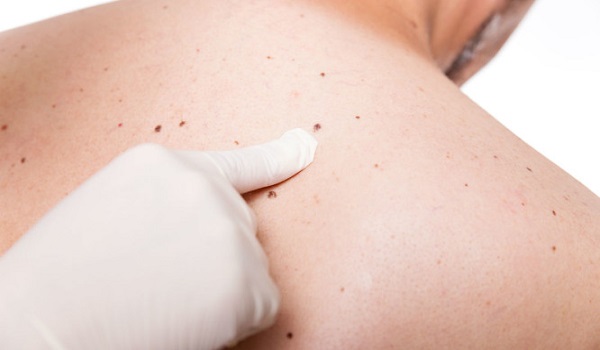 Ελιές στο δέρμα: Αυτά τα 5 σημάδια προειδοποιούν για καρκίνο