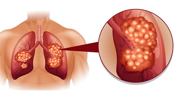 Καρκίνος του πνεύμονα: 8 σημάδια που πρέπει να γνωρίζετε