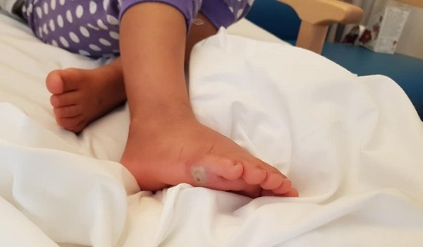 Κοριτσάκι κόλλησε θανατηφόρο μόλυνση, όταν έβαλε καινούργια παπούτσια ξυπόλυτη