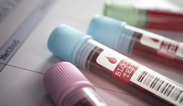 Καρκίνος παγκρέατος: Νέο τεστ αίματος για την έγκαιρη διάγνωσή του