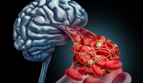 Ανεύρυσμα εγκεφάλου: Προσοχή στα «αθώα» συμπτώματα