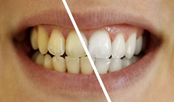 Πώς να έχετε λευκότερα δόντια χωρίς οδοντόβουρτσα