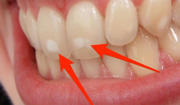 Παθογόνα στο στόμα προκαλούν καρκίνο έδειξε μεγάλη έρευνα