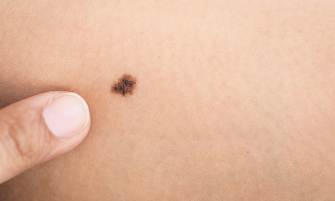 Ελιές στο δέρμα: Αυτά τα 5 σημάδια προειδοποιούν για καρκίνο