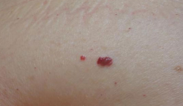 Κόκκινες ελιές στο δέρμα: Μην τις αγνοείτε – Τι μπορεί να σημαίνουν