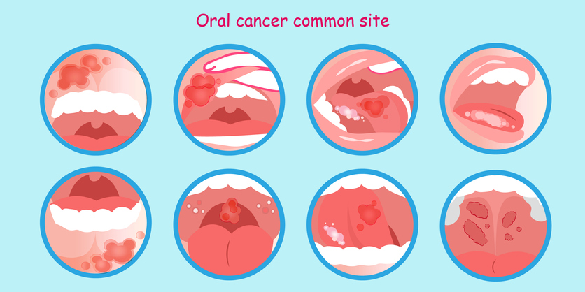 Καρκίνος στο στόμα: Σε ποια σημεία εμφανίζεται – Συμπτώματα, αίτια και θεραπεία