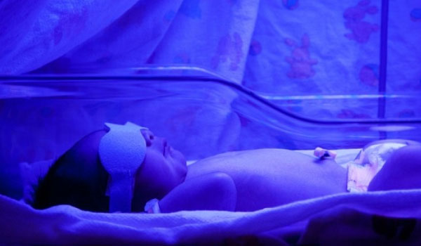 Μωρά με ίκτερο: Ποιο θανάσιμο κίνδυνο κρύβει η φωτοθεραπεία