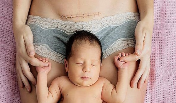Οι 7 αλήθειες που θα καταλάβουν μόνο οι γυναίκες που γέννησαν με καισαρική