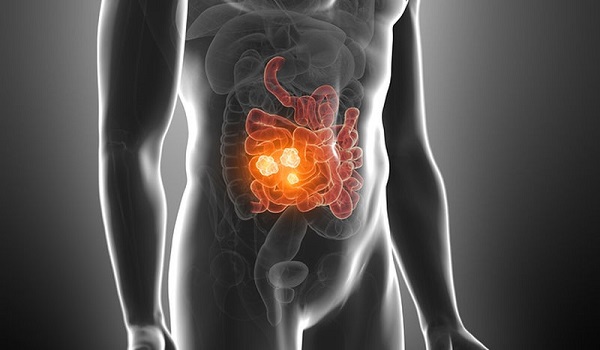 Καρκίνος εντέρου: Ποια τροφή σκοτώνει το 75% των όγκων σύμφωνα με νέα έρευνα