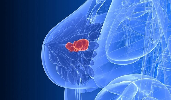 Καρκίνος μαστού: Ανοσοθεραπεία εξαφάνισε την ασθένεια σε γυναίκα που βρισκόταν στο τελικό στάδιο