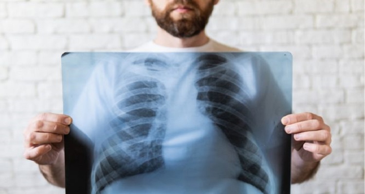 Καρκίνος του πνεύμονα: Αυτά είναι τα συμπτώματα – Μπορεί να φανεί ακόμα και στα μάτια