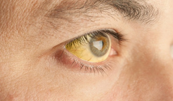Κίτρινα μάτια: Τι σύμπτωμα είναι – Ποιοι πρέπει να προσέχουν