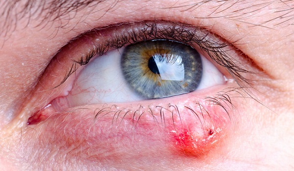 Κριθαράκι στο μάτι: Δείτε τις 4 φυσικές θεραπείες