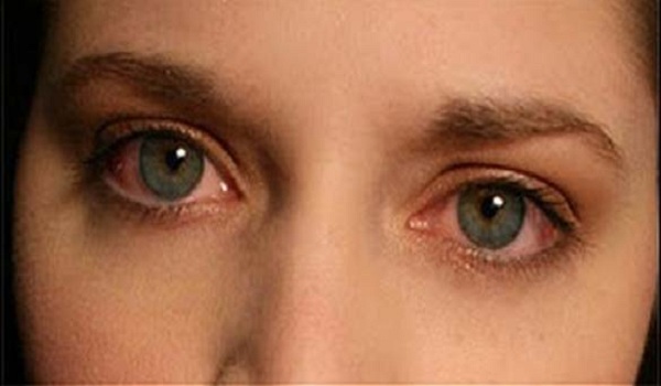 Μάτια που κοκκινίζουν: 10 πιθανές αιτίες και  τι να κάνετε