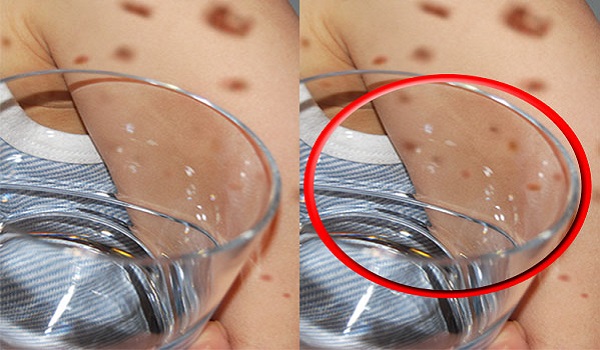 Μηνιγγίτιδα – Σημάδι στο δέρμα: Πώς γίνεται επιτόπου το τεστ με το ποτήρι