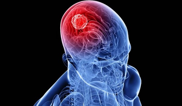 Όγκος στο κεφάλι: Προσοχή σε συμπτώματα, αίτια και παράγοντες κινδύνου