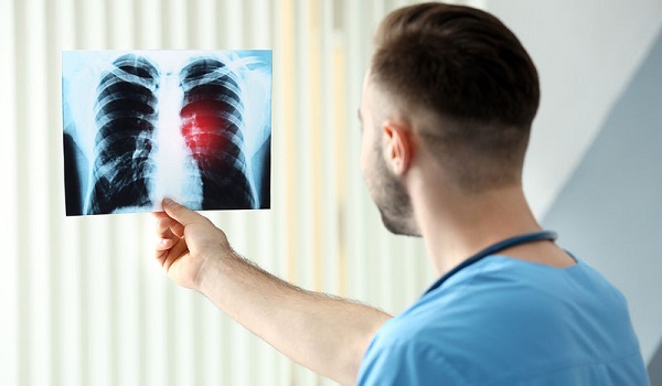 Καρκίνος πνεύμονα: 3η αιτία θανάτου στην Ελλάδα