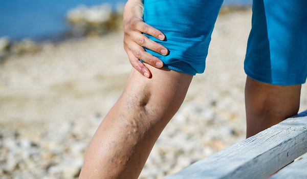 Θρόμβωση στο πόδι: Τα σημάδια που δεν πρέπει να αγνοήσετε