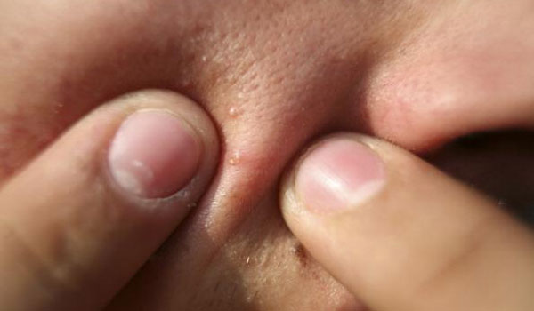 Τι συμβαίνει στο δέρμα σας όταν σπάτε τα σπυράκια