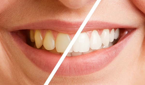Στοματική υγεία: Κοινά λάθη & μύθοι για τη φροντίδα των δοντιών