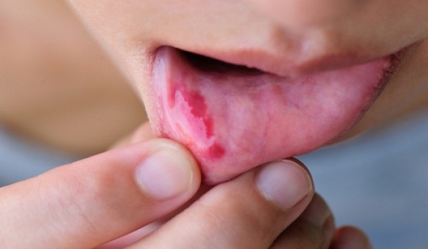 Καρκίνος του στόματος: Δείτε τα αθόρυβα συμπτώματα