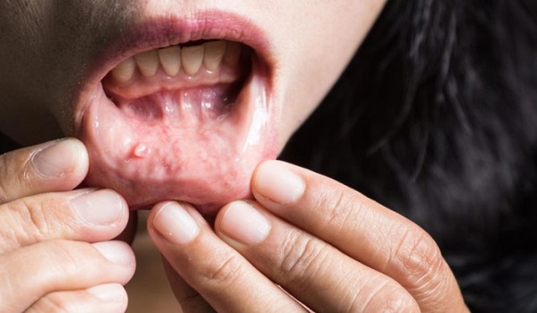 Καρκίνος του στόματος: Προσοχή στα αθώα συμπτώματα.  Ποιοι είναι οι παράγοντες κινδύνου