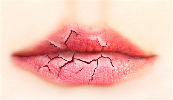 Έξι φυσικές λύσεις για τα σκασμένα χείλη
