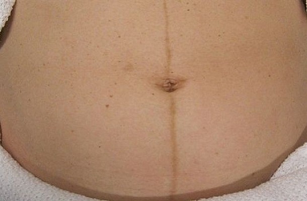 Που οφείλεται η μαύρη γραμμή που παρατηρείται στην κοιλιά μιας εγκύου;