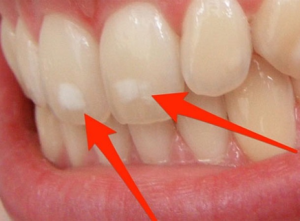 Η συνήθεια που καταστρέφει τα δόντια και δεν το φανταζόμαστε