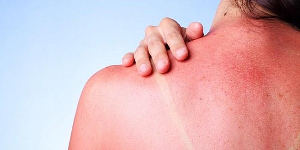 Αλλεργία στον ήλιο: Τι είναι και πώς να την αντιμετωπίσετε