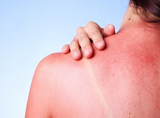Αλλεργία στον ήλιο: Τι είναι και πώς να την αντιμετωπίσετε