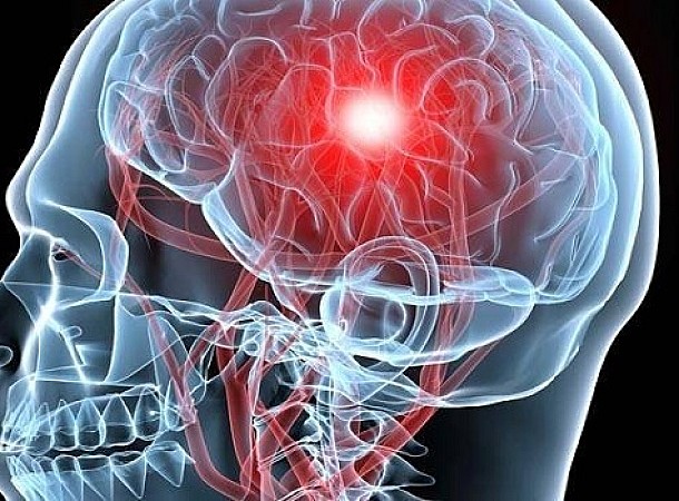 Εγκεφαλικό: Σε ποια άλλα μέρη του σώματος αφήνει σημάδια