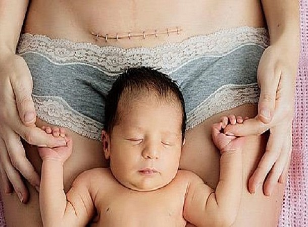 Οι 7 αλήθειες που θα καταλάβουν μόνο οι γυναίκες που γέννησαν με καισαρική
