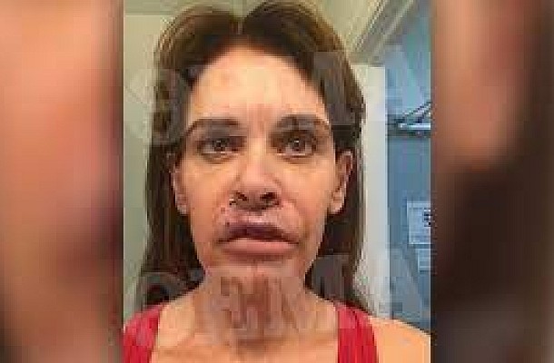 Ελληνίδα συγγραφέας είδε τα χείλη της να σαπίζουν μετά από πλαστική επέμβαση